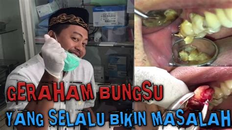 Proses Pencabutan Geraham Bungsu Atas Termudah Dan Tercepat Plus Tidak