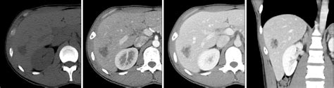 Figure 2 From Peribiliary Cysts Developed In Normal Underlying Liver