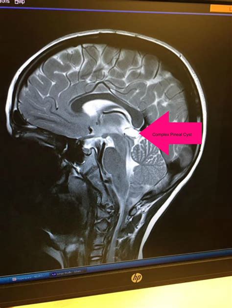 Pineal Gland Mri