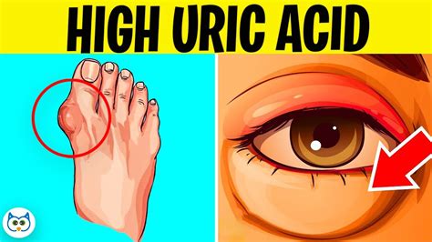 7 Symptoms of High Uric Acid Levels In The Body | Public Content ...