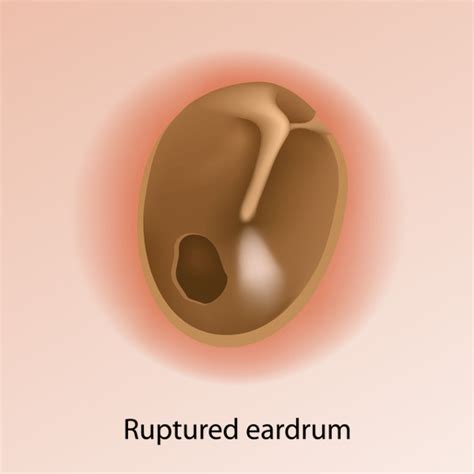 Tympanic Membrane Perforation | ENT Kerimis Clinic Ears,Nose, and ...