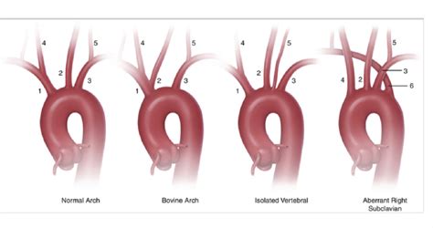 2 Aortic Arch Branching Patterns 1 Brachiocephalic Artery 2 Left Download Scientific