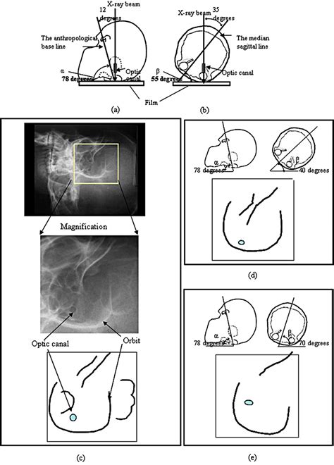 X-ray image and schemas of the left optic canal in the various ...