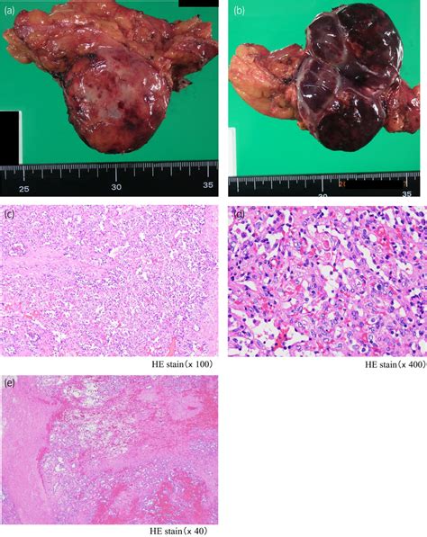 Histopathological Findings A B Macroscopically A Well‐demarcated