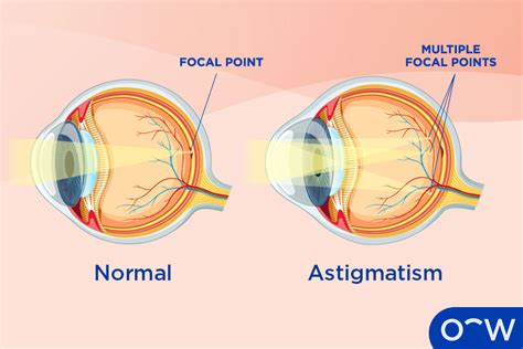 Astigmatism Eye