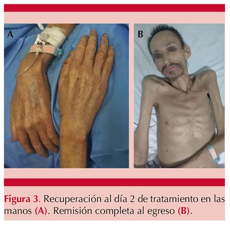 Sarna noruega costrosa Dermatología Revista mexicana