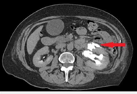 Axial Contrast Ct Scan Showing Extravasation Of The Contrast At The Download Scientific Diagram