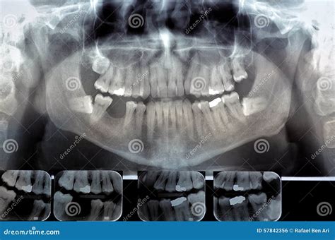 Dental Radiography Digital X Ray Teeth Scan Of Adult Male Stock Photo