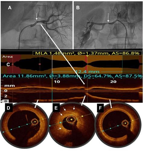 Current Bilateral Renal Angiogram Showing Significant Restenosis Download Scientific Diagram