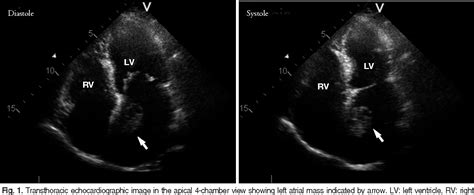 Figure 1 From Left Atrial Mass With Stalk Thrombus Or Myxoma