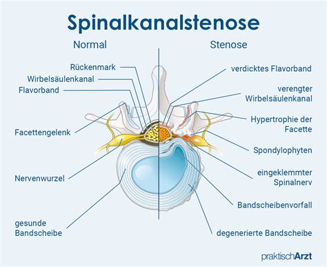 Spinalkanalstenose Symptome Und Therapie Gesundheit De Hot Sex Picture