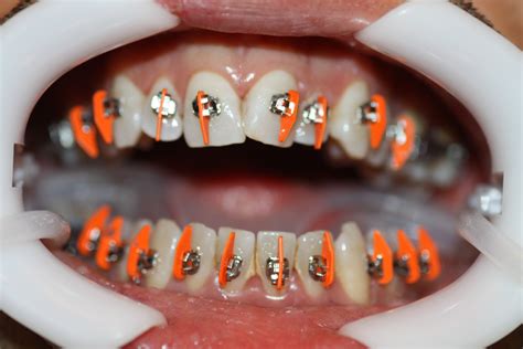 ¿cómo Se Colocan Los Brackets De Un ‘aparato Dental Vélez And Lozano