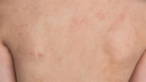 Closeup Junge Zur Ck Mit Ekzem Atopischer Dermatitis Haut