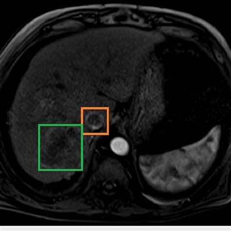 Abdominal Mri T Showing Inferior Vena Cava With Thrombus And Hepatic