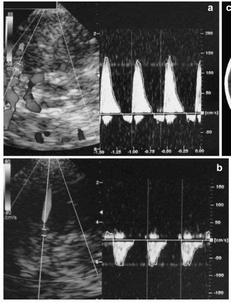 Transcranial Doppler Vascular Ultrasound Subarachnoid Hemorrhage