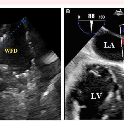 Echocardiography of a left atrial appendage remnant pre-and post ...