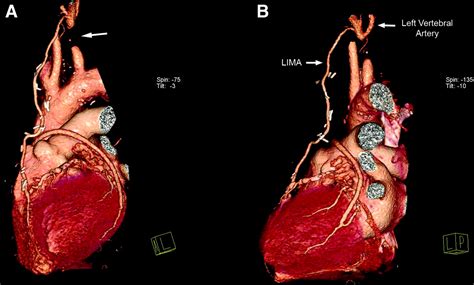multimodality imaging  coronary subclavian vertebral steal syndrome