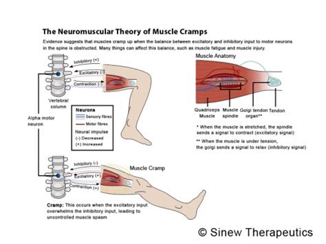 Muscle Cramps Spasms Information - Sinew Therapeutics