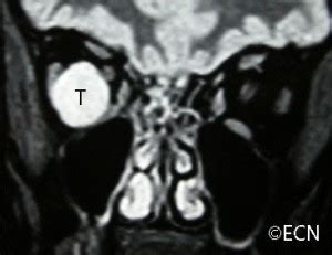 Choroidal Melanoma New York Eye Cancer Center