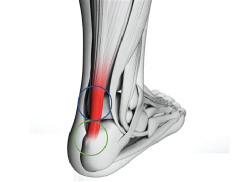 Achilles Tendinopathy Podiatry Quest