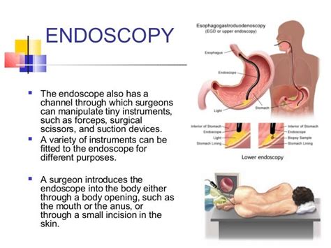 Endoscopy