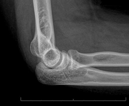 Radial head fracture | Radiology Case | Radiopaedia.org