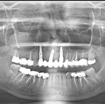 Painless Root Canal Treatment RCT In Indore Seraphic Dental Clinic