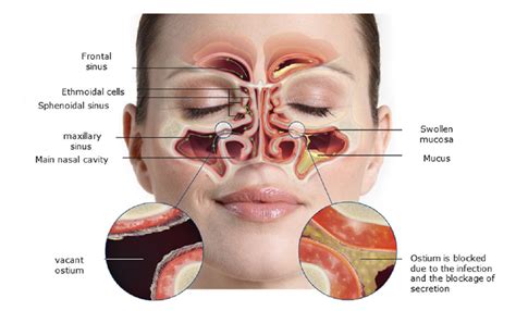 Swollen Sinuses