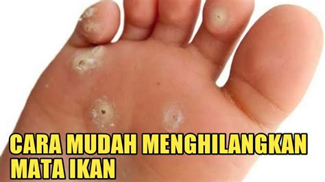 Cara Mudah Menghilangkan Mata Ikan Mata Ikan Di Kaki Pengobatan