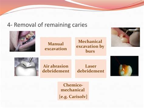 Principles Of Cavity Preparation Ppt