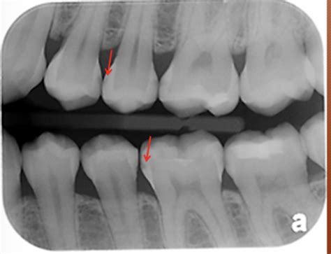 Radiology Ii Radiographic Interpretation Of Dental Caries Flashcards