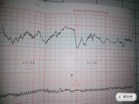 胎心监护图怎么看，胎心曲线看胎儿健康酷知经验网