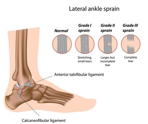 Anterior talofibular ligament (ATFL) | Antrim ED Meducation