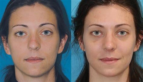 Facial Assymmetry Correction In Princeton Nj