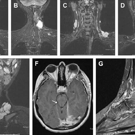 Venous Malformation Involving The Tongue Masticator Space And