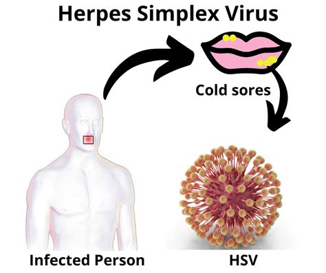 Herpes On Lips Causes | Lipstutorial.org