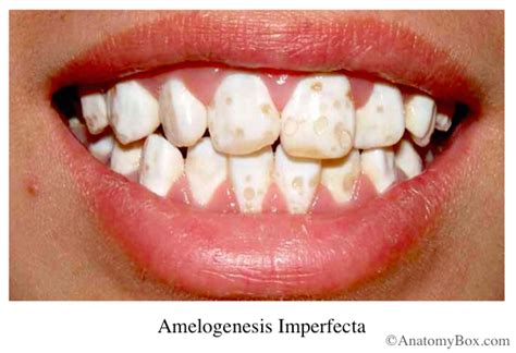 Image result for amelogenesis imperfecta | Dentistry, Dental, Genetics