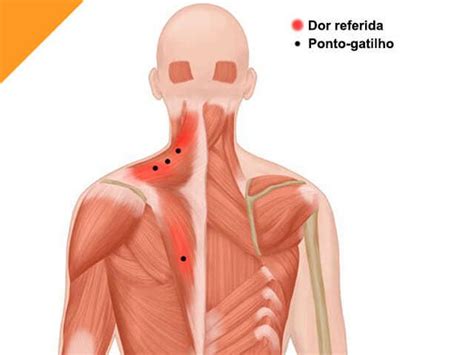 Desativação dos Pontos gatilho alivia Dor Miofascial MUNDO SEM DOR