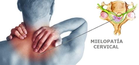 Mielopatía Cervical Causas Sintomas Y Tratamientos Columna Vertebral