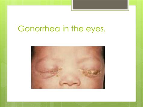 Gonorrhea Symptoms Eyes Resthunder