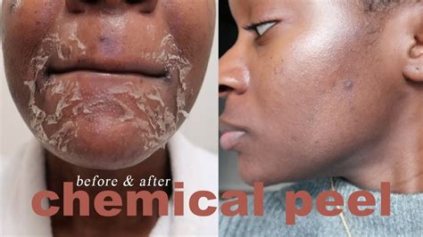 Chemical Peel For Dark Spots Acne And Large Pores Before And After