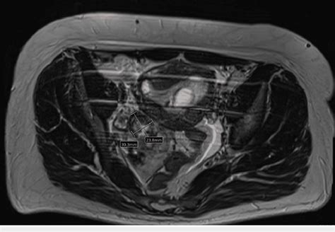 Cross Sectional MRI Demonstrating A Complex Right Adnexal Lesion