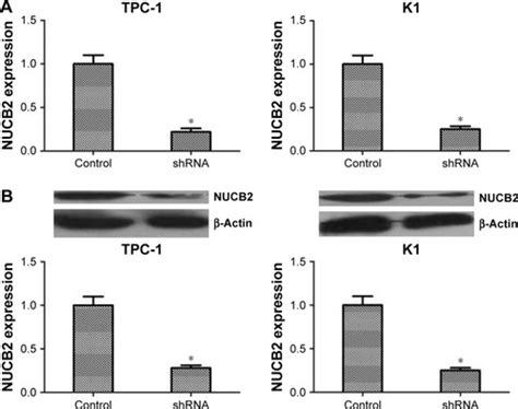 Full Article High Expression Of Nucb Promotes Papillary Thyroid