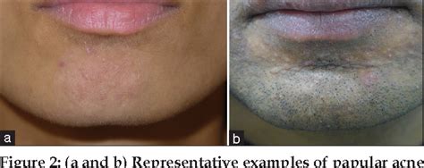 Figure 1 from Papular Acne Scars of the Nose and Chin: An Under-recognised Variant of Acne ...