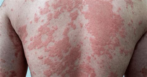 Psoriasis Types Symptoms Causes And Effective Management Shuai Cosmetics