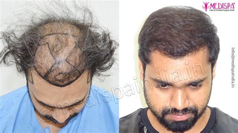 Hair Transplant Mumbai Before After Hair Transplant Dubai Cost