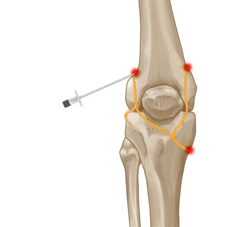 Genicular Nerve Radio Frequency Ablation Procedure And Recovery Thomas J Hong Do