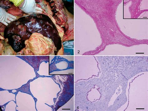 Gross Liver Microscopic Lesion And Special Staining In Liver Of