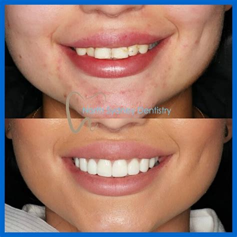 Dental Veneers North Sydney Dentistry