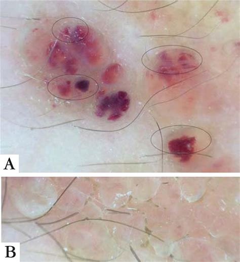 SciELO Brasil Cutaneous Lymphangioma Circumscriptum Dermoscopic